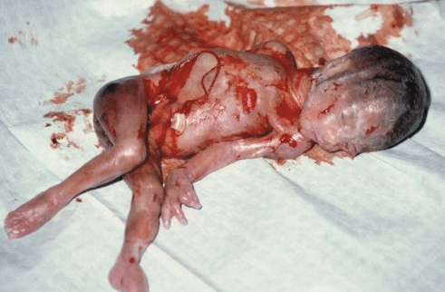 Image result for ABORTO