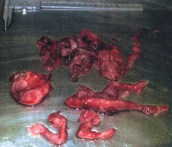 Planned Parenthood hace negocio vendiendo trozos de fetos abortados