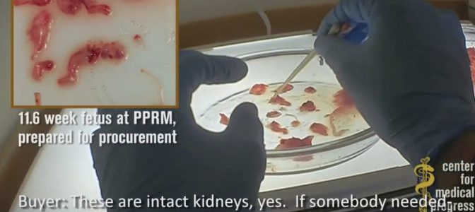 Planned Parenthood selecciona los restos de los fetos asesinados para venderlos